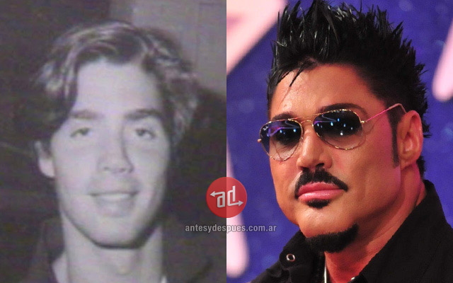 Lip augmentation of Ricardo Fort