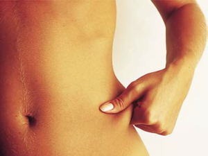 existe-diferenca-entre-a-gordura-boa-e-a-ruim