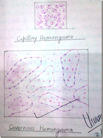 capillary hemangioma and cavernous hemangioma diagram histopathology