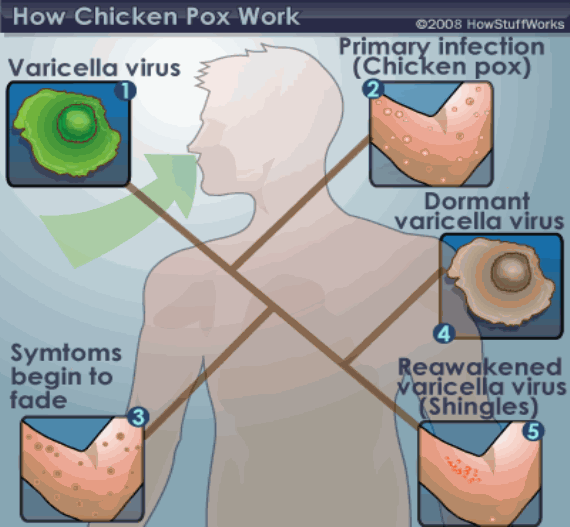 chicken-pox-virus-cell-5414