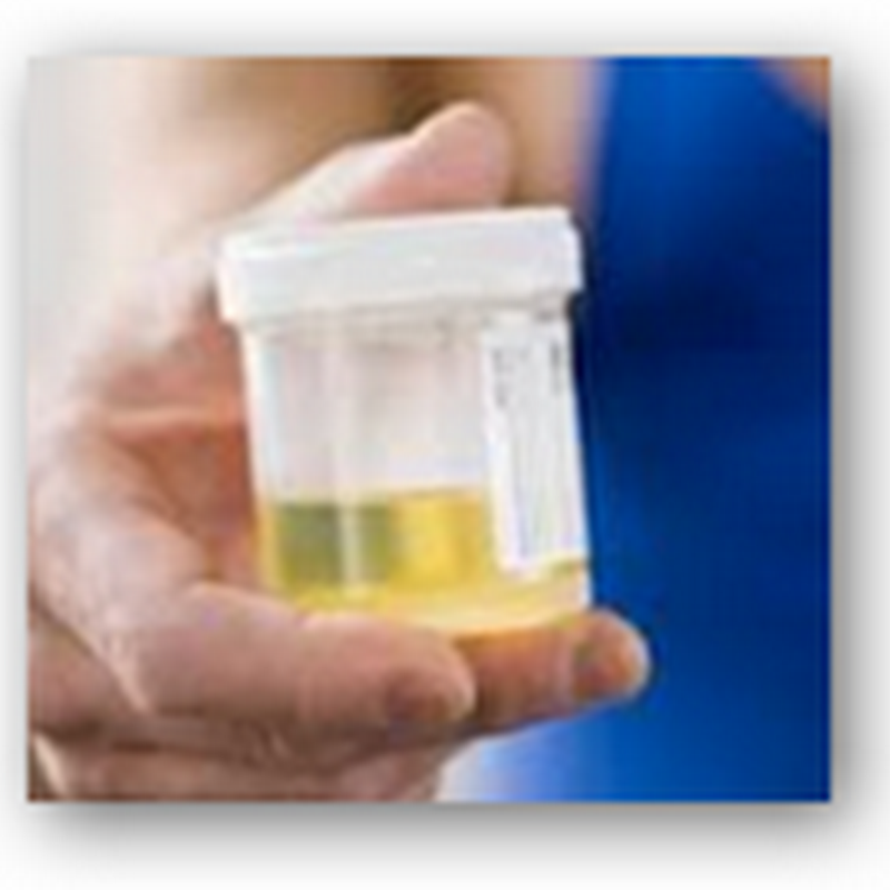 Prostate Cancer Foundation Announces Availability of  3 Marker Urine Test For Prostate Cancer, More Specific Than PSA Test Alone