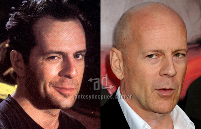 Hair Loss Before & After of  Bruce Willis