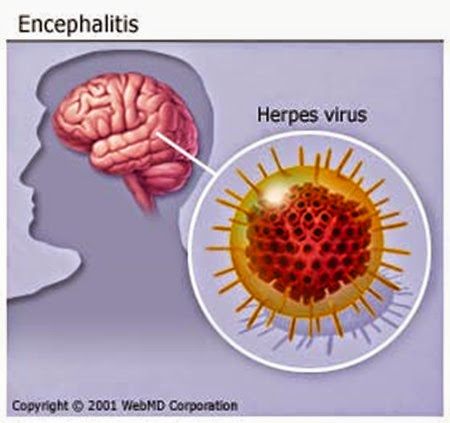 viral-encephalitis-15997_0