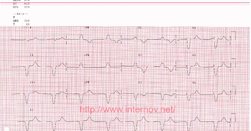 Гиперкалиемия на экг картинки