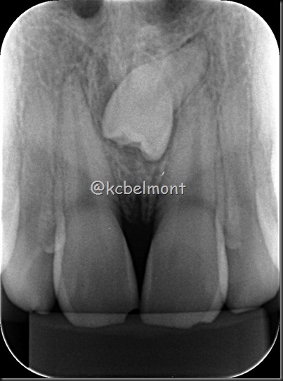 mesiodens periapical