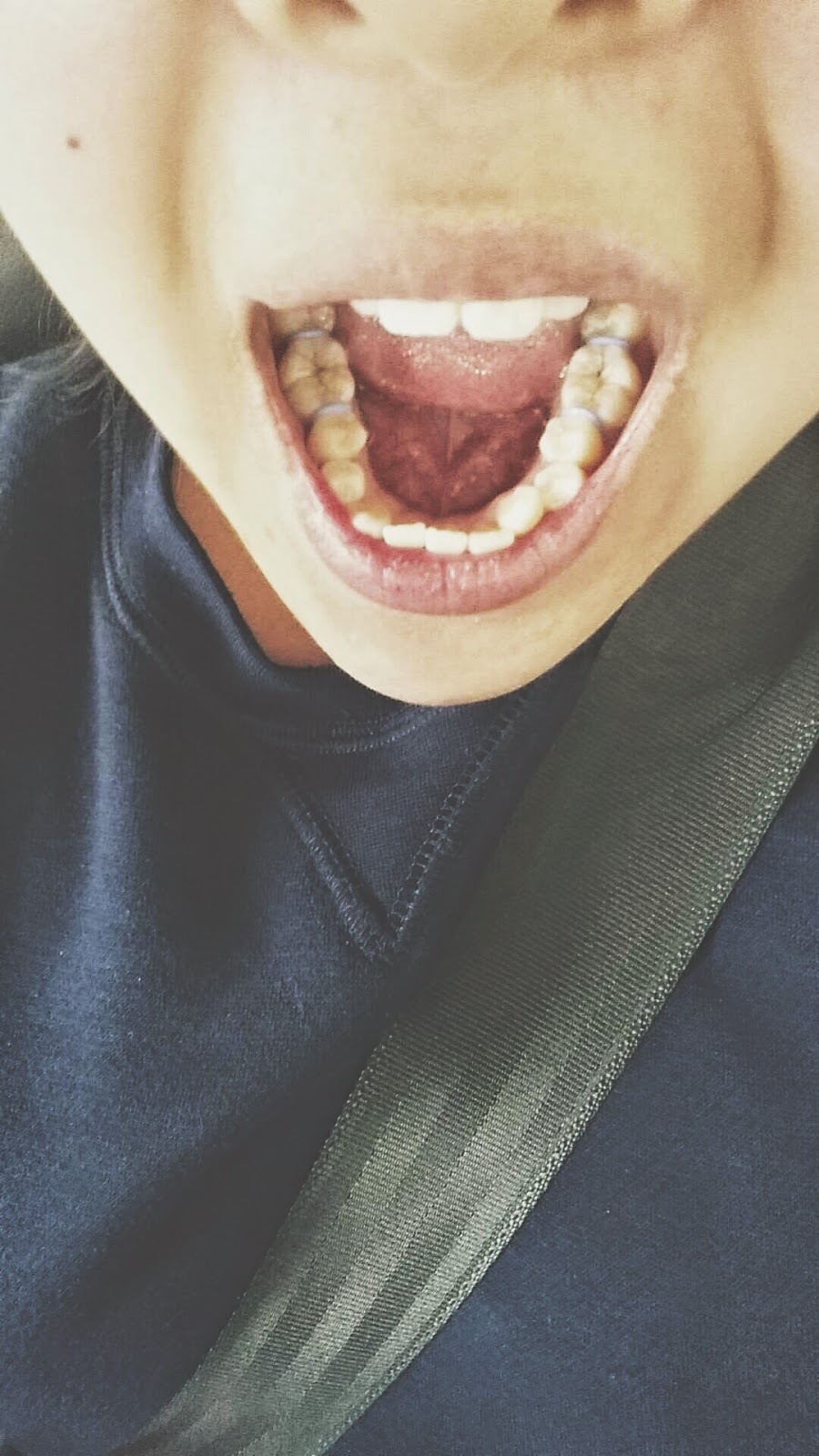 My Braces Journey First appointment + got my spacers on!