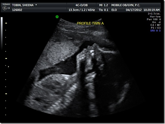 25 week ultrasound 002
