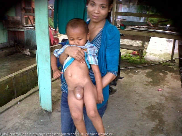 [Putri%2520Bersama%2520Rendra%252C%2520putranya%2520yang%2520mengalami%2520penyakit%2520kemaluan%2520membesar.Foto-B%2520Saragih.%255B16%255D.jpg]