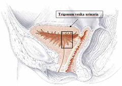 fistula vesiko vaginalis