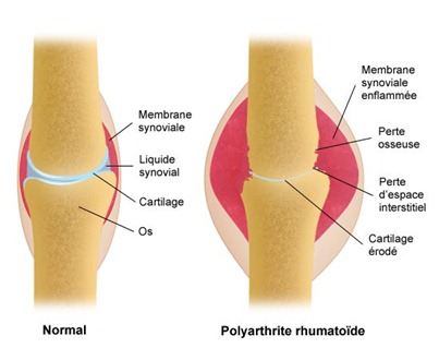 polyarthrite_g