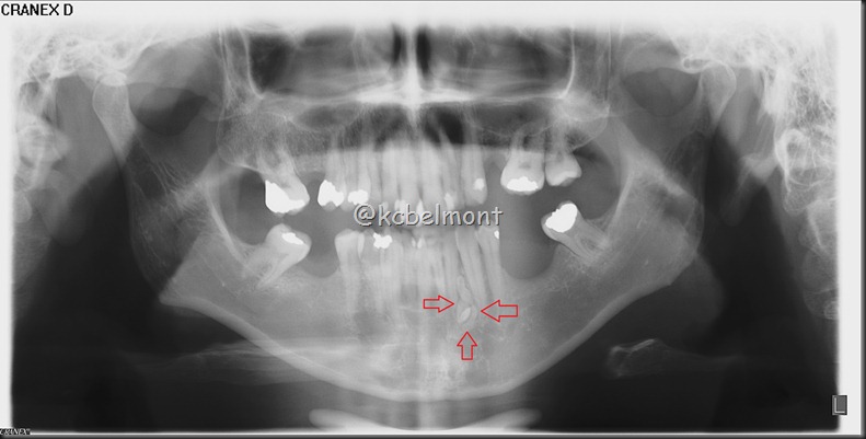 odontoma post