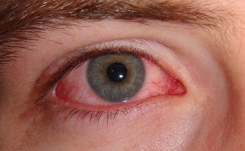 home remedies for eye infections_2
