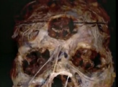 cranio com 3 olhos1