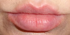 lips after using Kaplan MD Lip 20 Mask