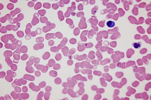 red blood cells infected New Automatic Test for Malaria to Reduce Requirement on Trained Clinicians, Bring Testing Into The Field