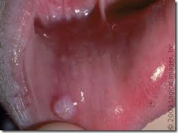 bump inside lower lip, retention cyst