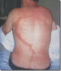 Lichtenberg figure on human skin