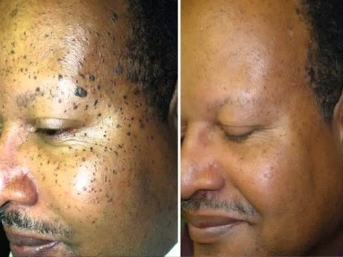 home remedies for mole removal_3