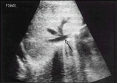Choledocholelithiasis in ultrasound