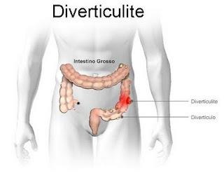 [diverticulite%255B5%255D.jpg]