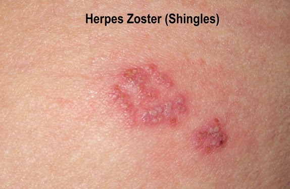 herpes-zoster-shingles