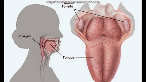 home remedies for tonsil stones_3