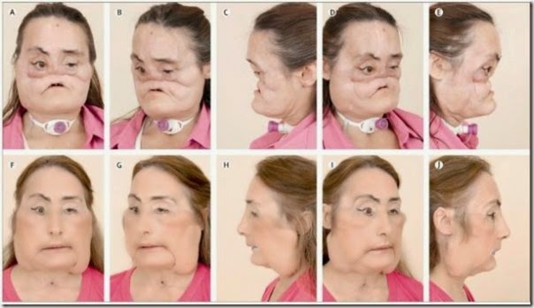 connie culp fotos transplante cara (1)