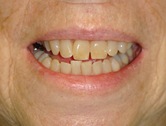 Patient A before whitening