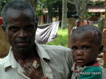 Un enfant malade du Monkey Pox, Equateur RDC