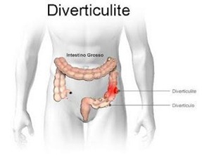 diverticulite