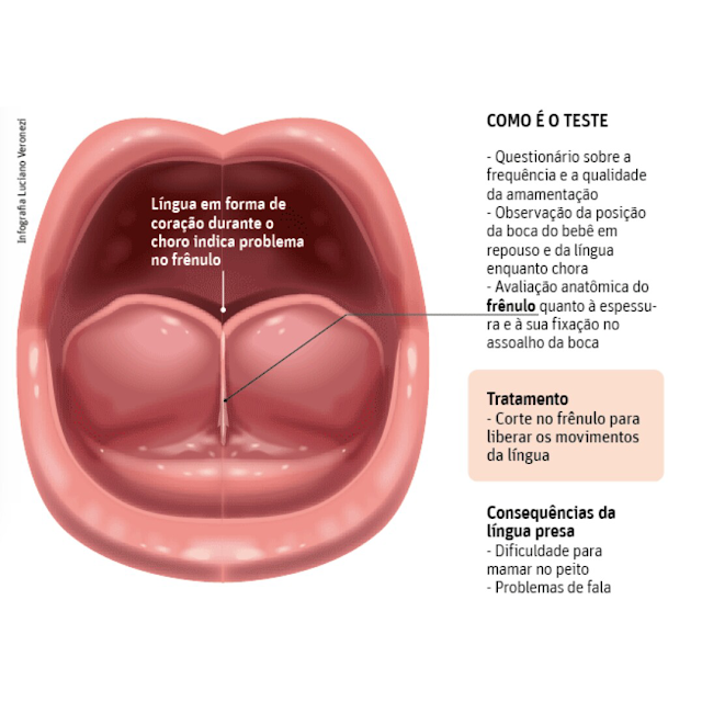 Dra. Renata Licciardi Endodontia Especializada e Clínica Geral Freio Lingual Dra. Renata Licciardi Endodontia Especializada e Clínica Geral Freio Lingual