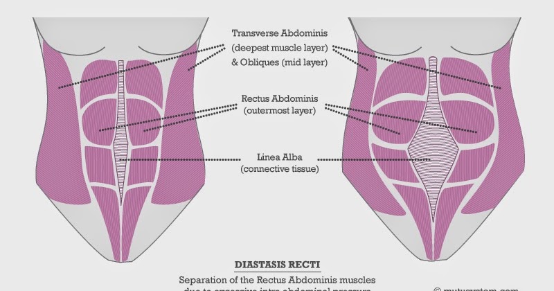 Embassy of Babies Blog: Do you have diastasis recti after child birth?