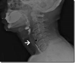 Barium Swallow showing dysphagia