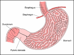 Stenosis Pylorus Congenital