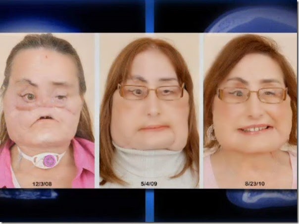 connie culp fotos transplante cara (5)