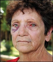 BADENHORST ALET 64 bloodied beaten eyes she and husband Paul 57 ATTACKED AT SKEERPOORT.jpghusband