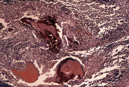 larvae breast infection. reaction around larva in