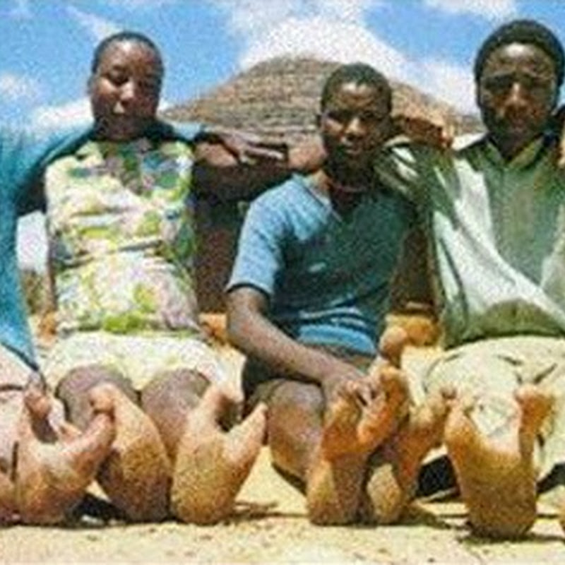 Malformación: pie de Avestruz tribu Vadoma de Zimbawe