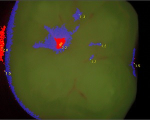 Molar 1.jpg
