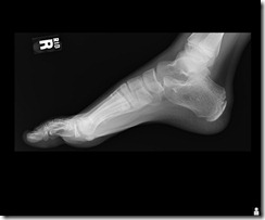 The x-ray of my son's foot after he stepped on a nail... ouch!