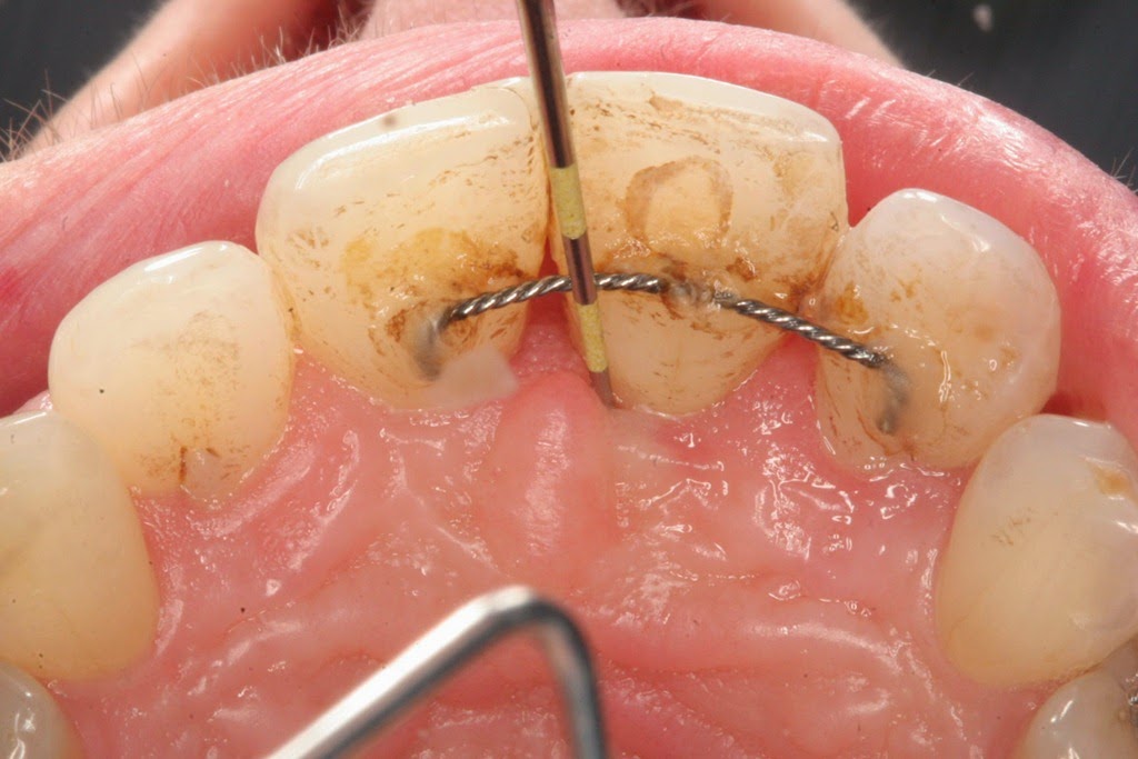 [home-remedies-for-abcessed-tooth_44.jpg]