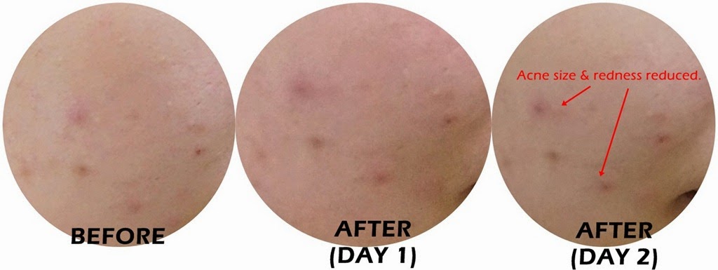 [cellnique%2520O2%2520derma%2520acne%2520result%255B7%255D.jpg.webp]