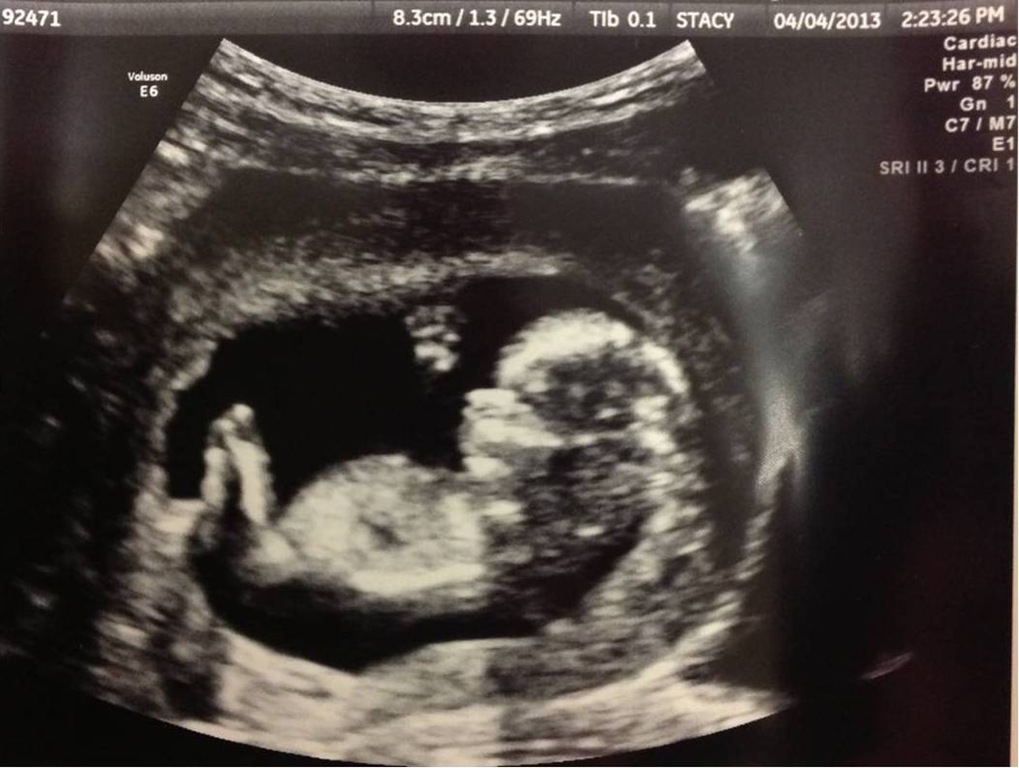 [baby-12-weeks-ultrasound-25.jpg]