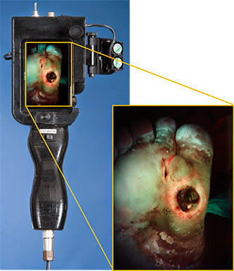 PRODIGI Image New Autofluorescence Imaging Platform Detects and Tracks Bacteria in Chronic Wounds