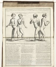 Vergroeide tweeling uit Hongarije, Judith en Helena