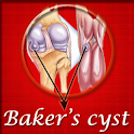 Bakers Cyst logo