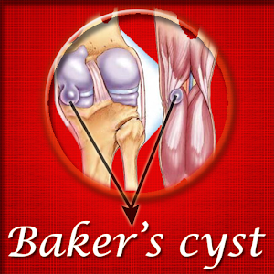 Bakers Cyst 1.0