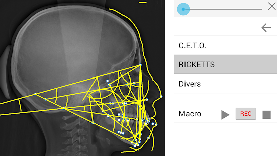 How to download Cephalometric Analysis 1.2.2 unlimited apk for laptop