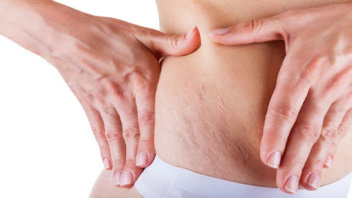 How To Get Rid of Stretch Mark
