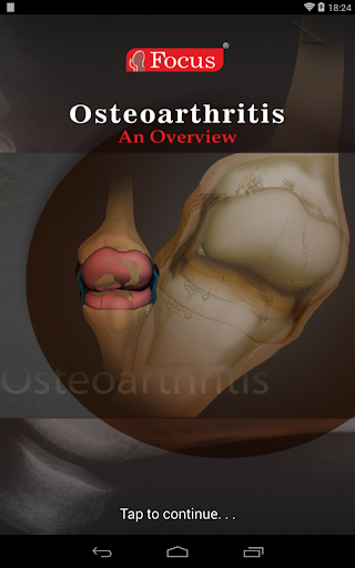 Osteoarthritis- An Overview